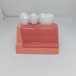 Maxi Implantat/Bro Studiemodel 